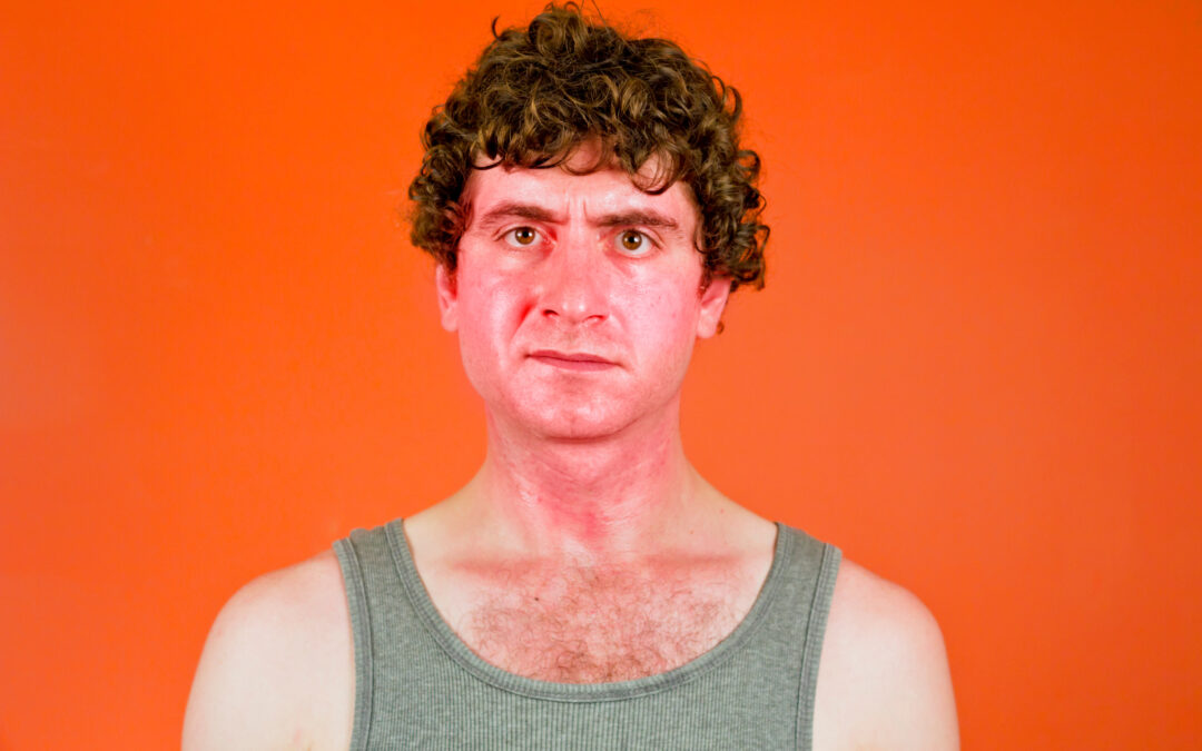 Signs Your Sunburn Needs Medical Attention